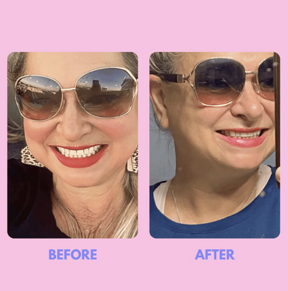 Hinium™ Necklift Tape